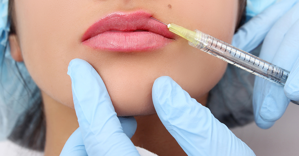 Needle administering a lip filler